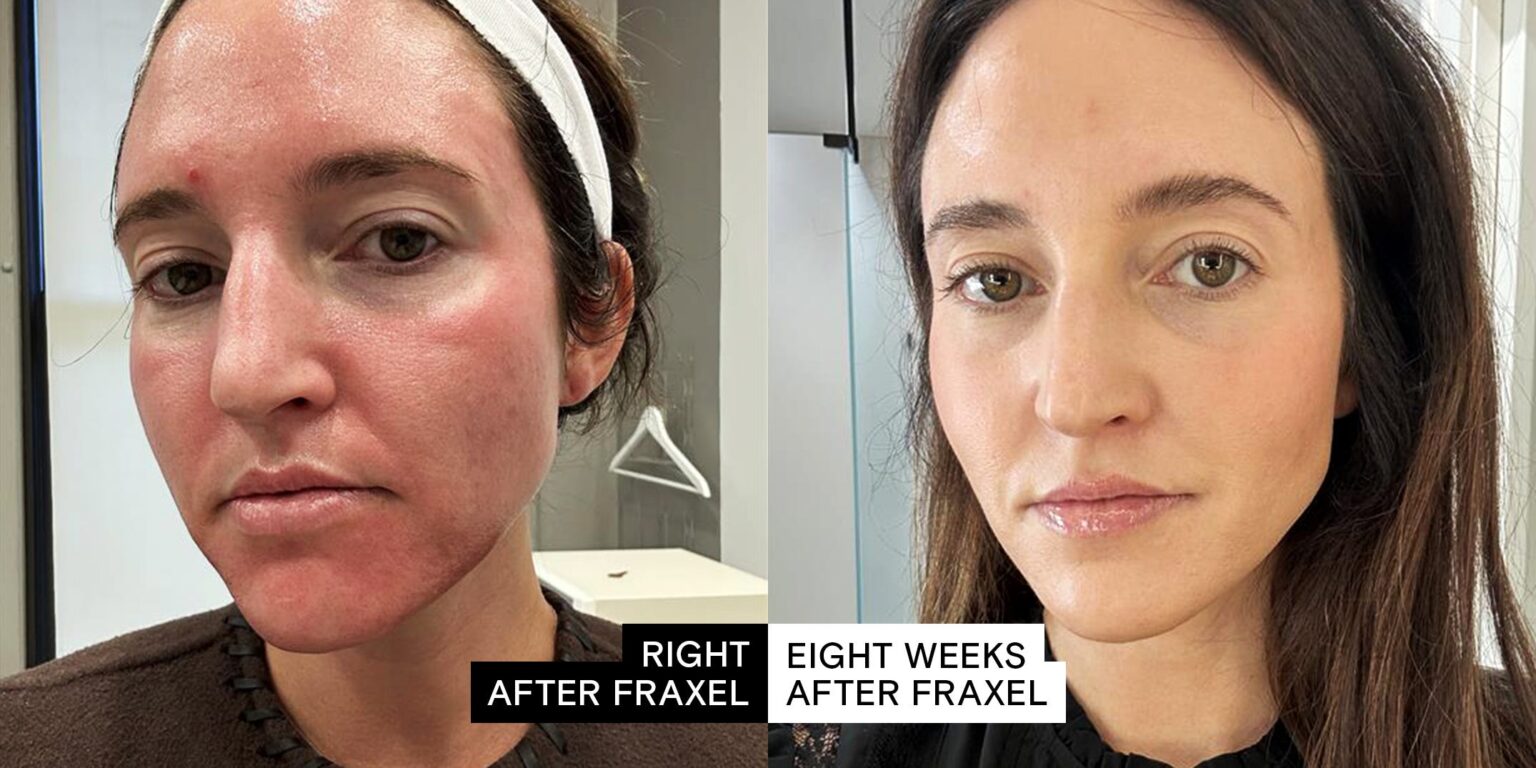 Fraxel Laser Burns Through Skin Problems With Brutal Efficiency Medical laser device in modern dermatology clinic