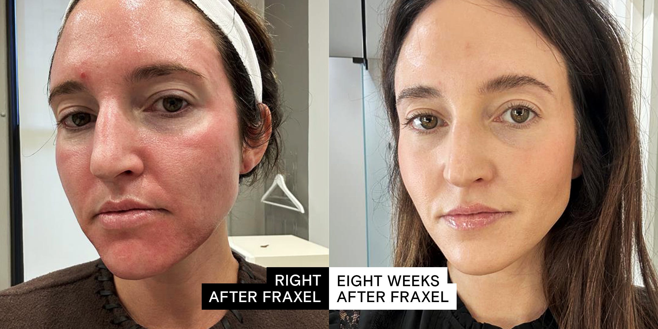 Medical laser device in modern dermatology clinic